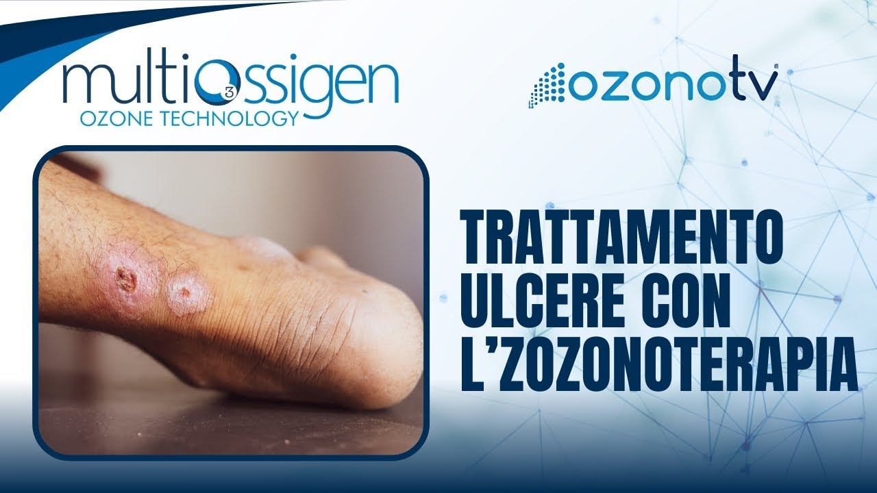 Miniatura video: Ozono TV | Trattamento ulcere